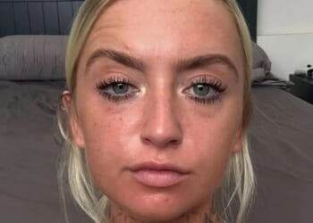 I was addicted to sunbeds at 24