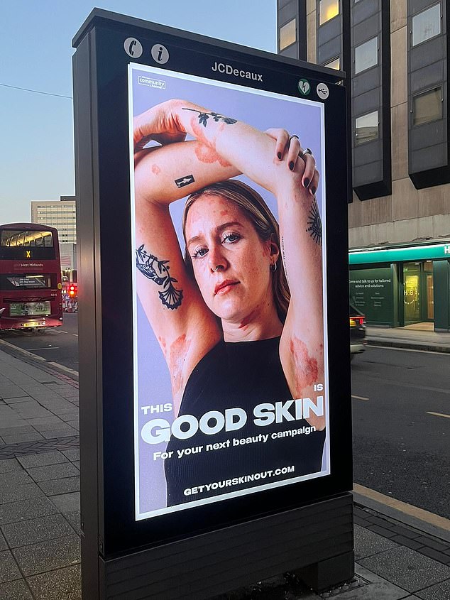 Along with around 15 other women, photos of my body - psoriasis on show - were featured on digital billboards in London and New York, photo taken by Kate Ford of Fordtography