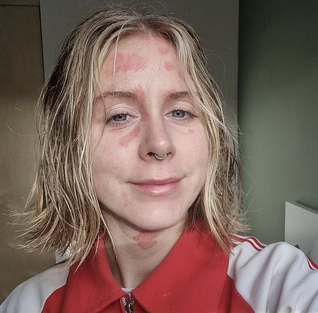 I’ve started sharing photos of my skin on social media. The more I do it, the easier it gets