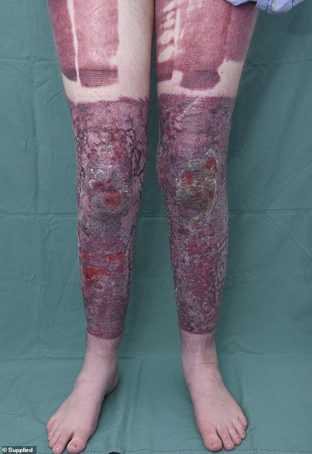 'I heard someone say, "Wow!;" Waghorn writes of the eruption. 'And someone else exclaimed, "Look at that!"' She is pictured on the day she was discharged from hospital as her legs were beginning to heal