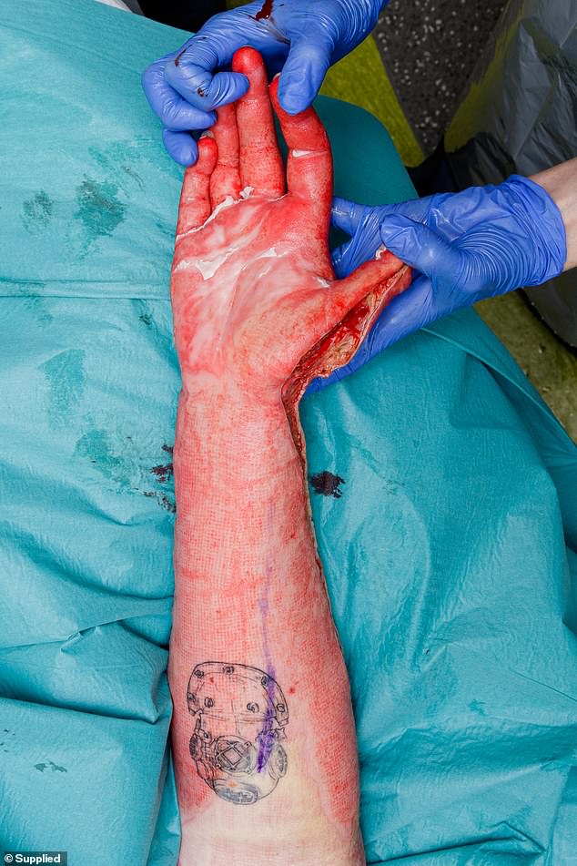'My exposed arms started to feel like they were on fire,' Kesley Waghorn writes in Surviving White Island.  A section of her right elbow (above) escaped damage because she kept her hands over her face as long as she could