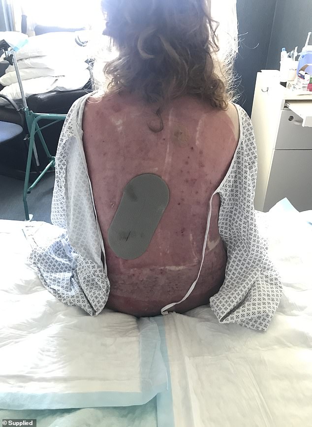 'Fear had filled my body as soon as I saw that ashen cloud barrelling down the island,' Waghorn writes. She is pictured recovering from her injuries, including severe burns to her back