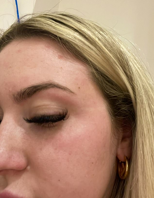 Phototherapy left Shannon with burn marks on her face