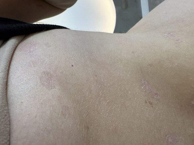 The scars left on Shannon's back from topical steroid use