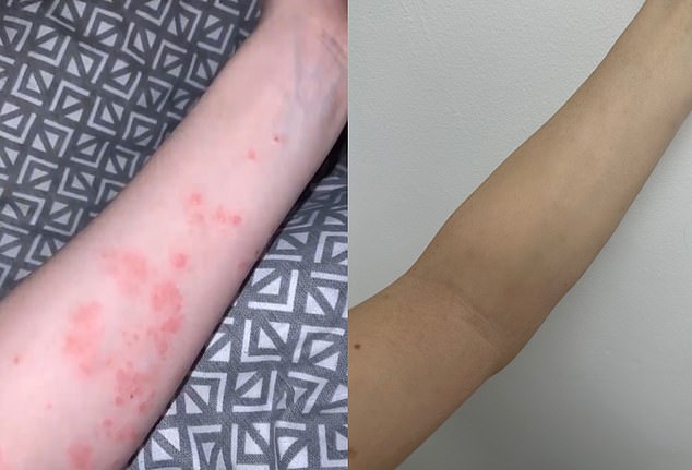 Shannon's skin is pictured before and after changing her skincare and diet