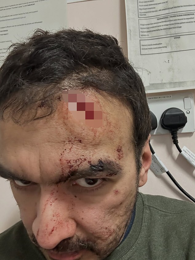 He asked them to move away - but the youths began shouting racist slurs at him before one hit him with a piece of wood, leaving his forehead split open down to the skull (pictured)