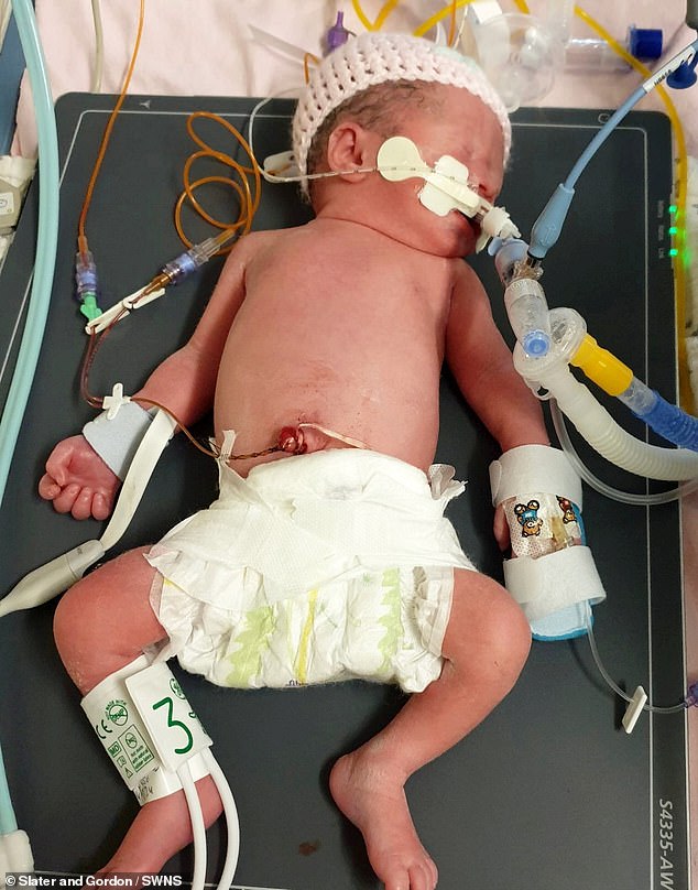 Olivia was born via emergency C-section and had to be resuscitated as she was suffering from severe hypoxic-ischaemic encephalopathy