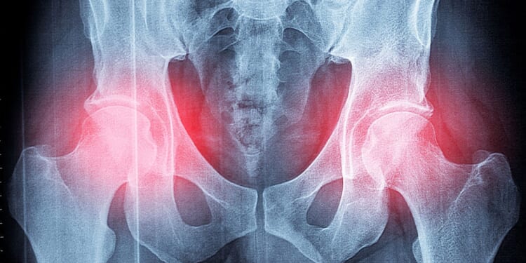 Thousands in agony as NHS slammed for denying patients hip and knee surgery due to high BMI