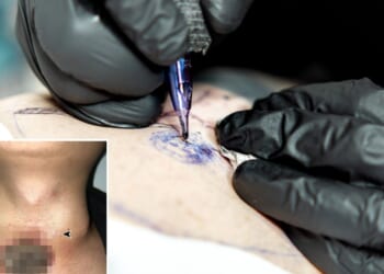 Man's neck turns black and flesh rots away months after getting neck tattoo which DISAPPEARED