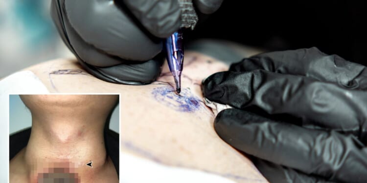Man's neck turns black and flesh rots away months after getting neck tattoo which DISAPPEARED