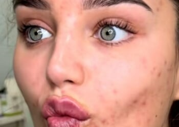 Lucinda Strafford praised as she shows off her 'real skin' while getting painful lip filler treatment