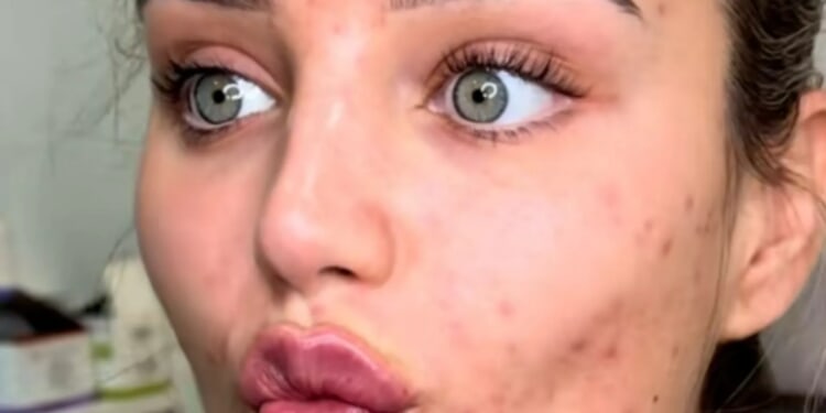 Lucinda Strafford praised as she shows off her 'real skin' while getting painful lip filler treatment