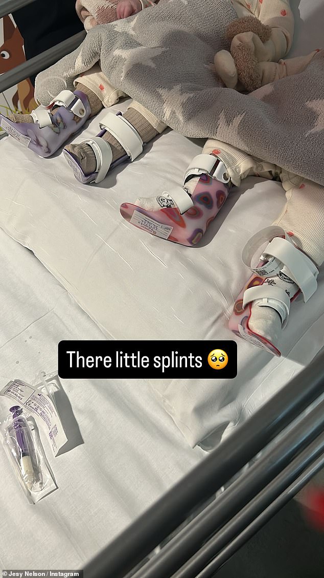 The tots could be seen snuggled up in a blanket as they shared the same bed, wearing splints on their legs