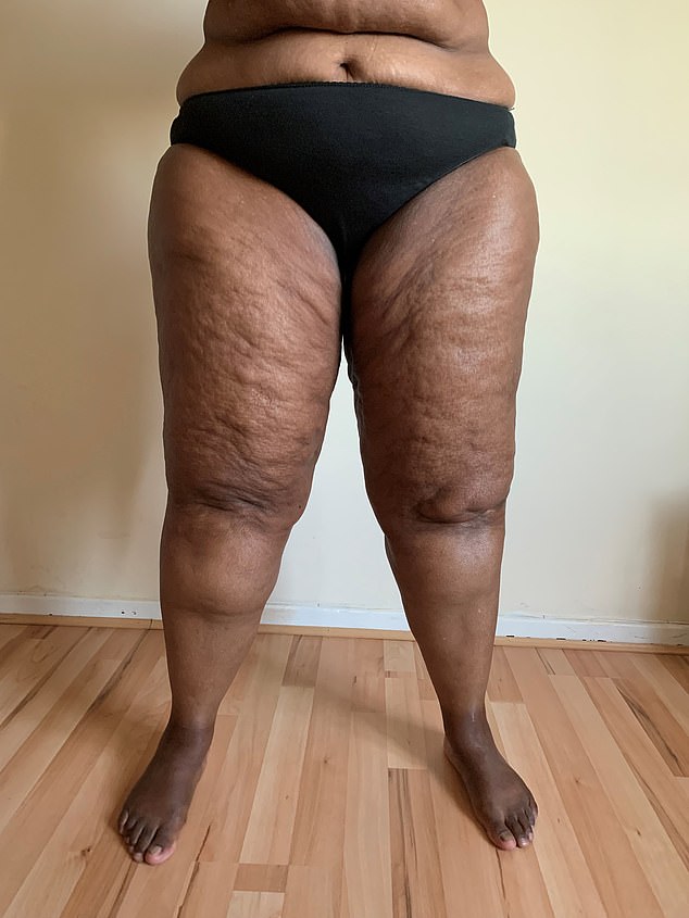 Lipoedema occurs when abnormal, bumpy fat (you can feel lumps under the skin) builds up, usually in the legs, buttocks and thighs, but also sometimes in the arms