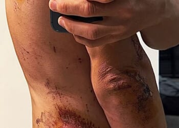 Former world champion cyclist Michal Kwiatkowski has shown off his brutal injuries from a recent crash