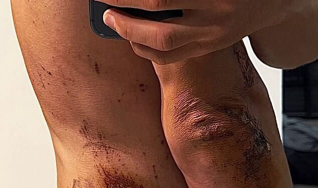 Former world champion cyclist Michal Kwiatkowski has shown off his brutal injuries from a recent crash