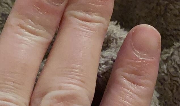 Elizabeth Misselbrook, 40, from Bracknell, Berkshire, had to have her finger chopped off by doctors after they discovered a brown line on her nail was a rare form of skin cancer