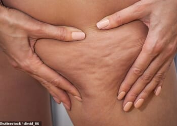 Both lipoedema and cellulite cause a dimpled ¿orange peel¿ texture - but the similarities often stop there