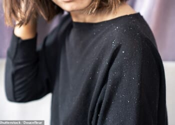 Dandruff is the mildest form of inflammatory skin flaking on the scalp ¿ the skin cells regenerate too fast, piling up on the scalp and then flaking off (picture posed by model)