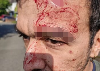 Boyan Chowdhury, who was a founding member of the indie rock band, said the attack happened in the Wavetree area of Liverpool on Saturday afternoon. Pictured: Images of his injury he shared to social media in the wake of the incident