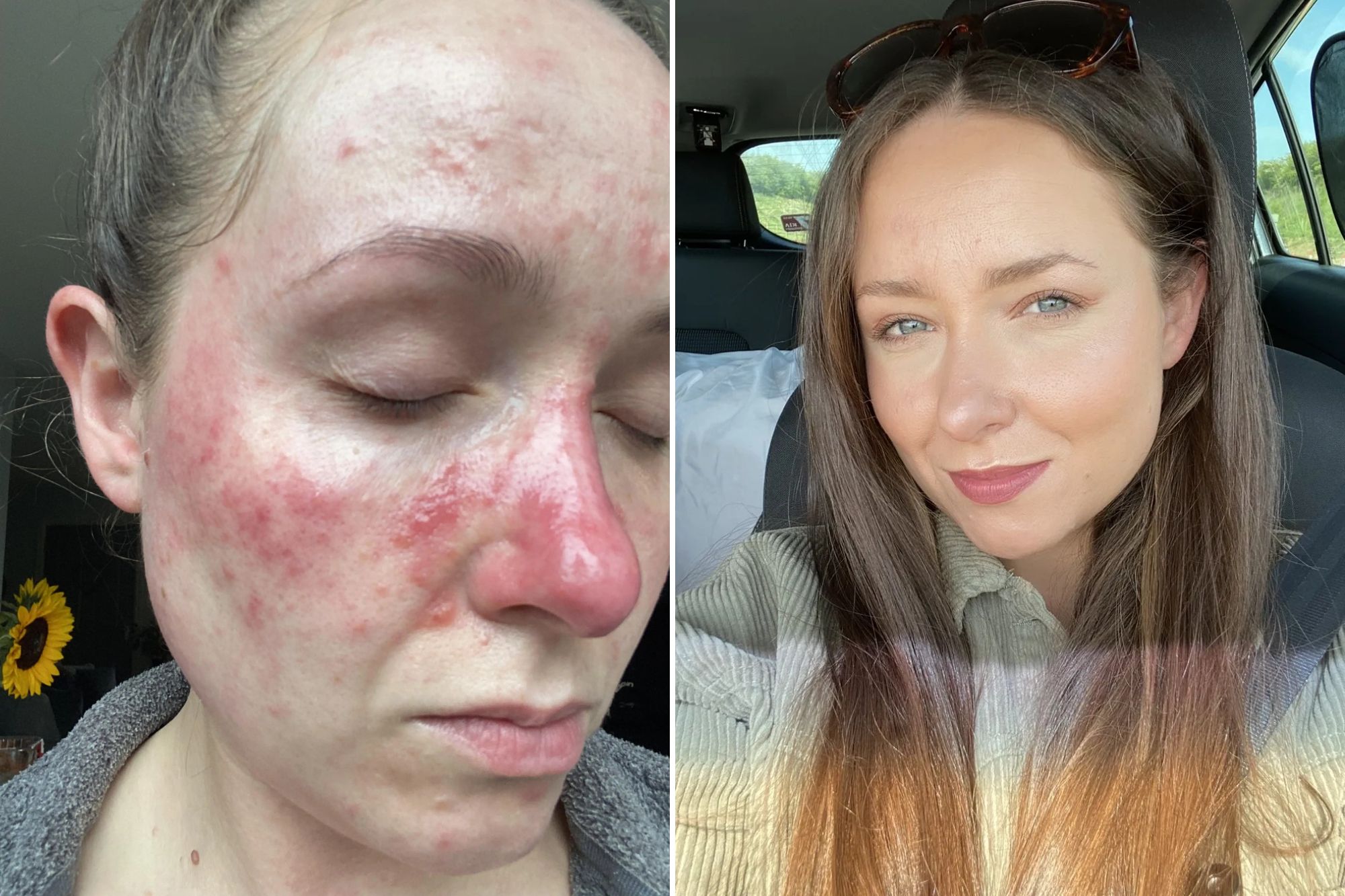An image collage containing 2 images, Image 1 shows Close-up of a person's face showing skin flare-ups, Image 2 shows Lydia Jennings, a mother who found a "miracle" product for her painful breakouts