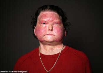 Joseph Dimeo remembers getting into his car after a long shift with little sleep. The next thing he knew, he was waking up three months later in a hospital, with 80 percent of his skin burned off