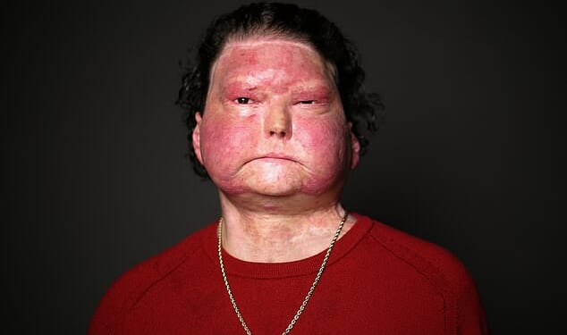 Joseph Dimeo remembers getting into his car after a long shift with little sleep. The next thing he knew, he was waking up three months later in a hospital, with 80 percent of his skin burned off