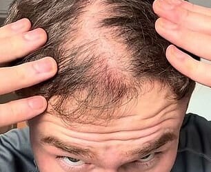 25-year-old Rob noticed his hair starting to thin