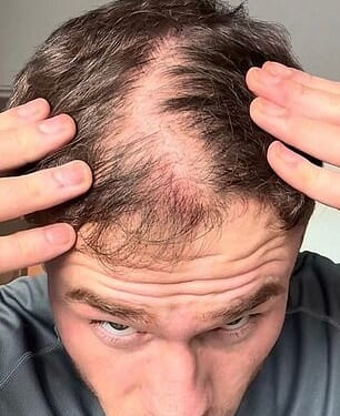 25-year-old Rob noticed his hair starting to thin