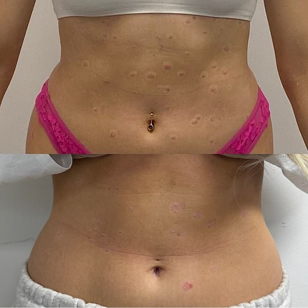 Shannon was left with indentations all over her body after steroid creams thinned her skin