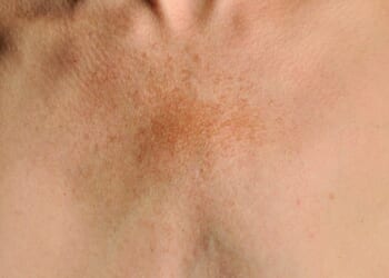 Pigmentation, fine lines or crepiness can particularly impact the décolletage
