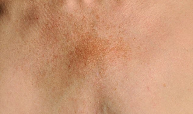Pigmentation, fine lines or crepiness can particularly impact the décolletage