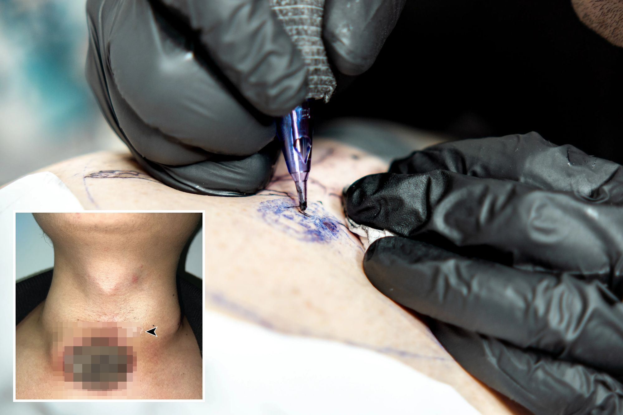 An image collage containing 2 images, Image 1 shows tattoo artist tattooing vitruvian man face, Image 2 shows Lateral neck mass (thymic cyst) with a black arrow pointing at the lesion