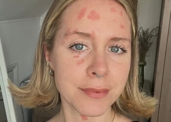 There’s no cure for psoriasis and no guaranteed treatment; 17 years on, my arms, legs and face are still speckled with red patches