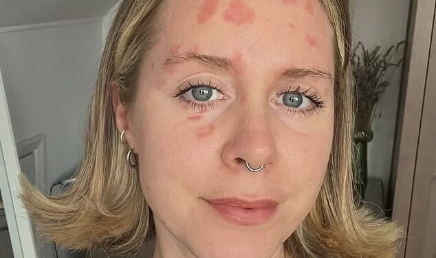 There’s no cure for psoriasis and no guaranteed treatment; 17 years on, my arms, legs and face are still speckled with red patches