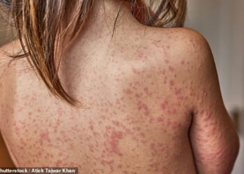 More than 60 suspected cases of measles are said to have been reported by seven schools and a nursery in Enfield