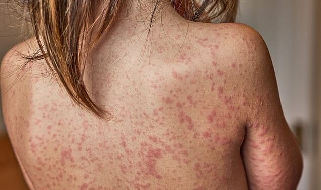 More than 60 suspected cases of measles are said to have been reported by seven schools and a nursery in Enfield