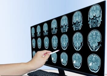 Chronic inflammation has been linked to depression, cognitive decline and brain fog