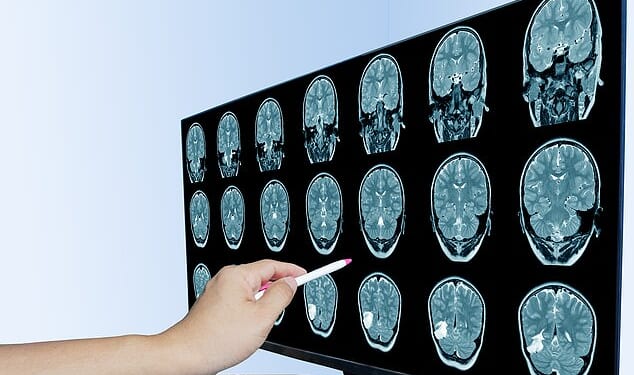 Chronic inflammation has been linked to depression, cognitive decline and brain fog