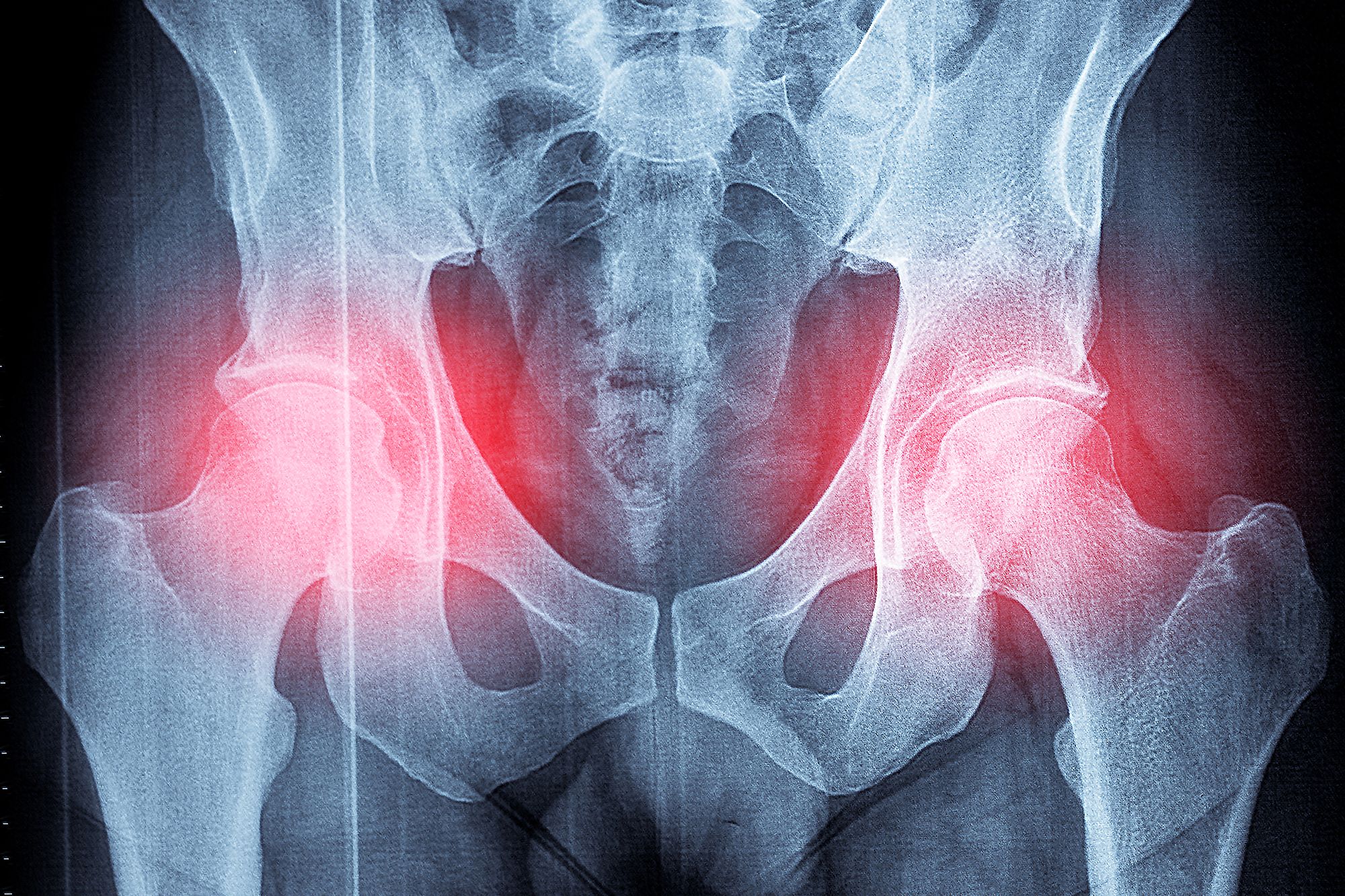 An image collage containing 1 images, Image 1 shows X-ray of a man's pelvis with a possible hip fracture