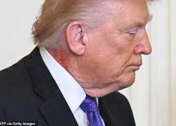 Donald Trump's neck was plagued by a painful-looking red rash as he attended a medals ceremony on Monday following a grueling 48 hours as the US went to war with Iran