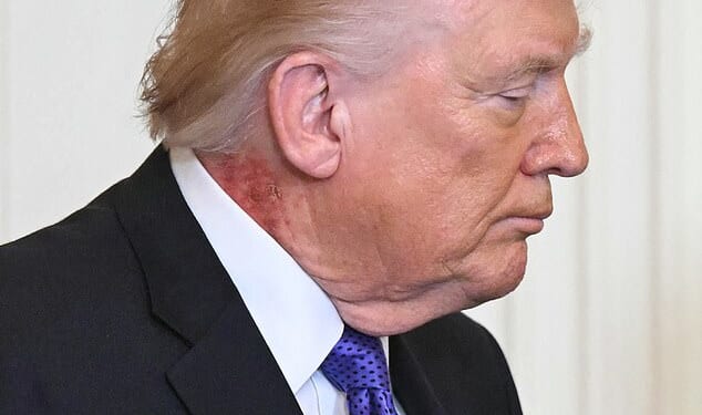 Donald Trump's neck was plagued by a painful-looking red rash as he attended a medals ceremony on Monday following a grueling 48 hours as the US went to war with Iran