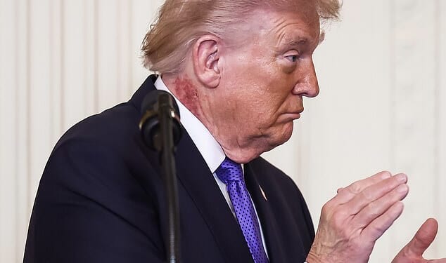 Experts speculate that Trump is suffering from actinic keratoses, an unsightly skin condition that increases the risk of skin cancer