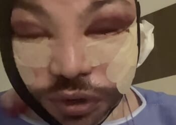 In a video shared to his Instagram the Only Way Is Essex star, 39, slurred his words as he gave his fans an update following his face and neck lift and lower blepharoplasty