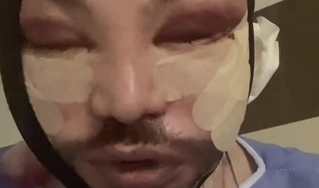 In a video shared to his Instagram the Only Way Is Essex star, 39, slurred his words as he gave his fans an update following his face and neck lift and lower blepharoplasty