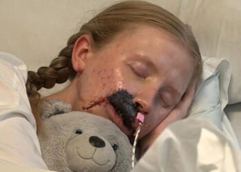 I was mauled by dog who ATE my face and ripped off my skin