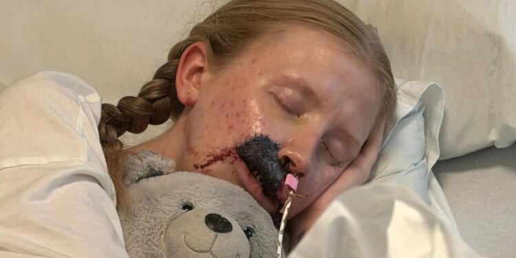 I was mauled by dog who ATE my face and ripped off my skin