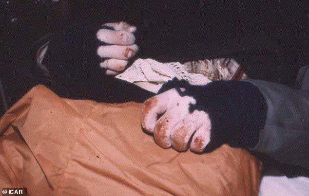 Mr Almqvist's hands, which suffered from frostbite, ended up having to be amputated