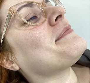 Her face after having the laser hair removal treatment