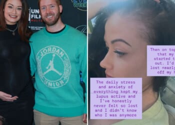 Pregnant Jess Impiazzi reveals devastating battle with lupus as hair falls out and rashes appear on her body
